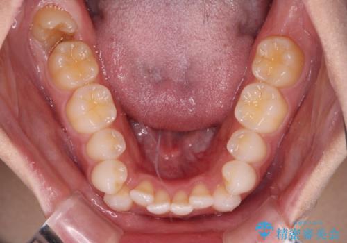 前歯のデコボコとクロスバイト ワイヤー装置での抜歯矯正の治療前