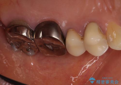 目立つ銀歯をセラミックに 奥歯の審美歯科治療の治療前