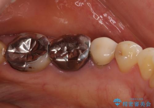 目立つ銀歯をセラミックに 奥歯の審美歯科治療の治療前