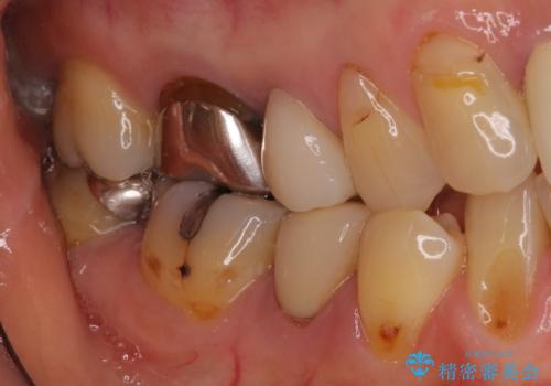 目立つ銀歯をセラミックに 奥歯の審美歯科治療の治療前