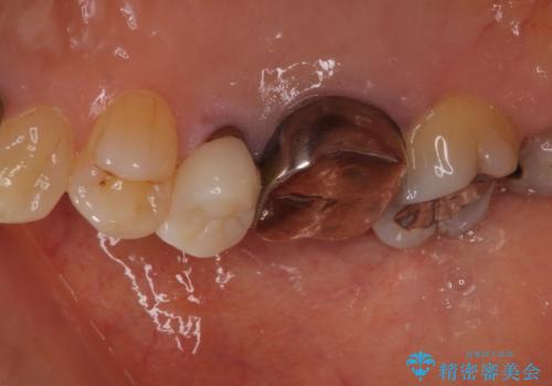 目立つ銀歯をセラミックに 奥歯の審美歯科治療の治療前