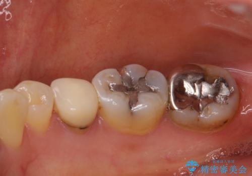 目立つ銀歯をセラミックに 奥歯の審美歯科治療の治療前
