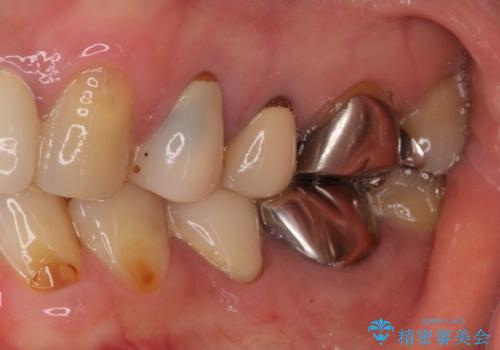 目立つ銀歯をセラミックに 奥歯の審美歯科治療の治療前