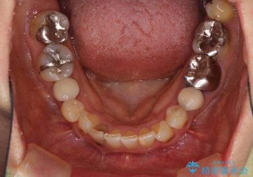 目立つ銀歯をセラミックに 奥歯の審美歯科治療の治療前