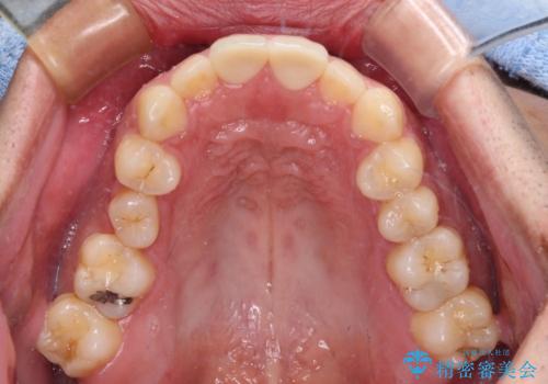 自転車で転んで前歯を損傷 前歯のオールセラミッククラウンの治療中