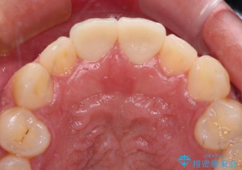 自転車で転んで前歯を損傷 前歯のオールセラミッククラウンの治療中