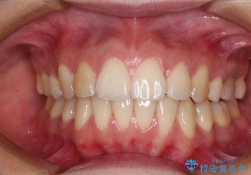 後戻りをインビザラインでスッキリした口元にの治療中