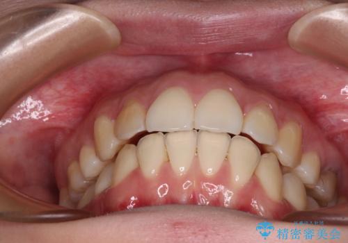 後戻りをインビザラインでスッキリした口元にの治療中