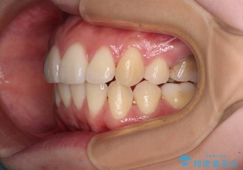 後戻りをインビザラインでスッキリした口元にの治療中