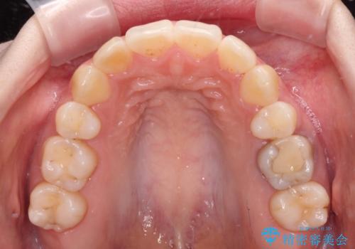 後戻りをインビザラインでスッキリした口元にの治療中
