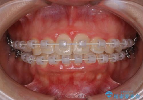 インビザラインが使えなかった:ワイヤーで仕上げ治療の治療中