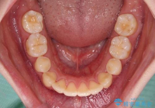 後戻りをインビザラインでスッキリした口元にの治療中