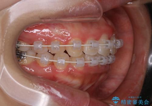 インビザラインが使えなかった:ワイヤーで仕上げ治療の治療中