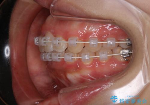 インビザラインが使えなかった:ワイヤーで仕上げ治療の治療中