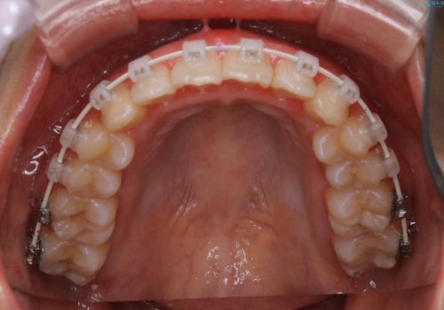 インビザラインが使えなかった:ワイヤーで仕上げ治療の治療中