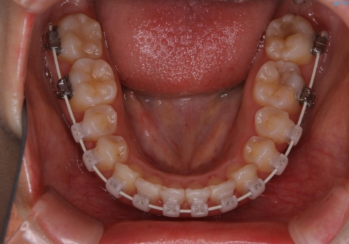 インビザラインが使えなかった:ワイヤーで仕上げ治療の治療中