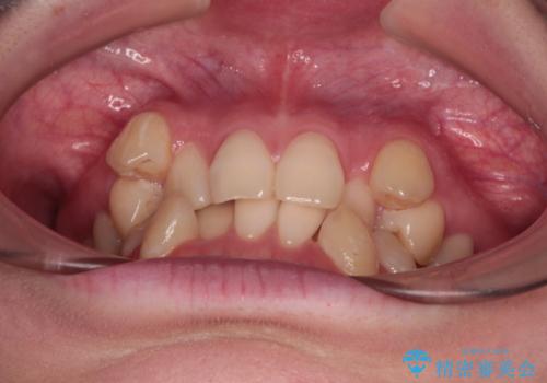 上下の八重歯とクロスバイト ワイヤー装置での抜歯矯正の治療前