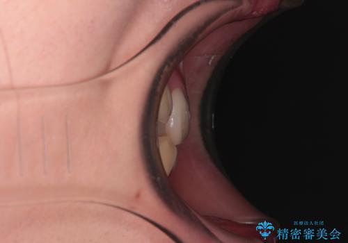 上下の八重歯とクロスバイト ワイヤー装置での抜歯矯正の治療前