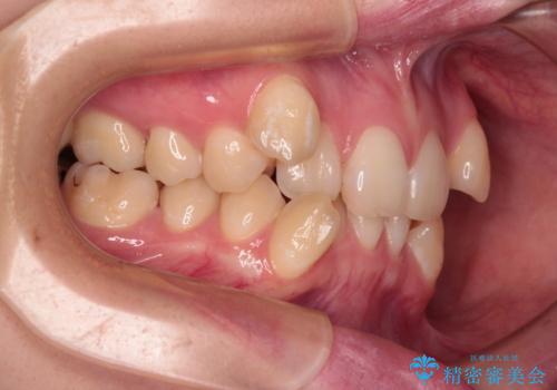 上下の八重歯とクロスバイト ワイヤー装置での抜歯矯正の治療前