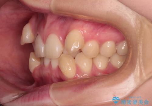 上下の八重歯とクロスバイト ワイヤー装置での抜歯矯正の治療前