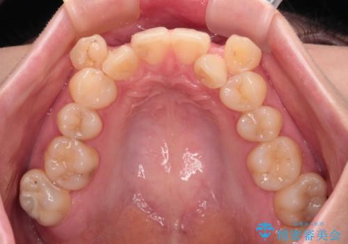 上下の八重歯とクロスバイト ワイヤー装置での抜歯矯正の治療前