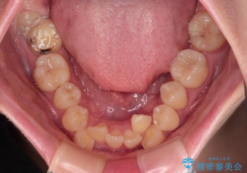 上下の八重歯とクロスバイト ワイヤー装置での抜歯矯正の治療前
