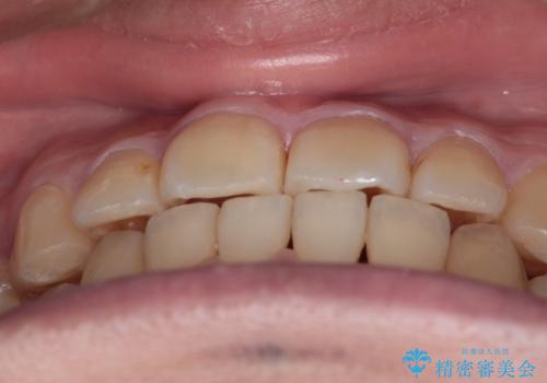 【クリア装置】前歯のがたつきが気になるの治療後