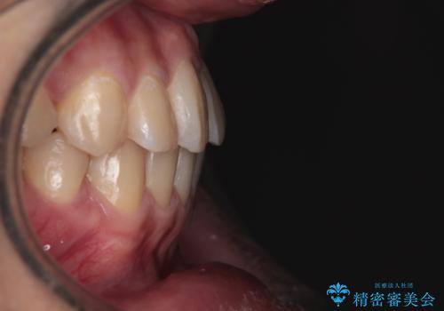 【クリア装置】前歯のがたつきが気になるの治療後