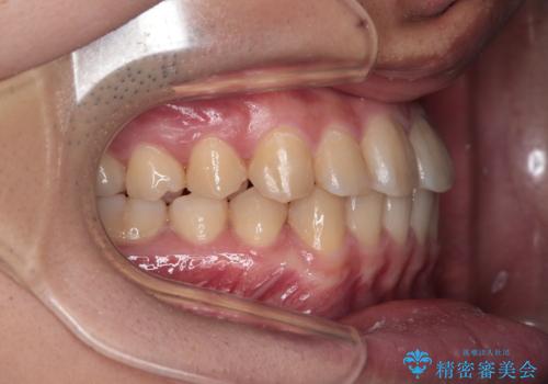 【クリア装置】前歯のがたつきが気になるの治療後