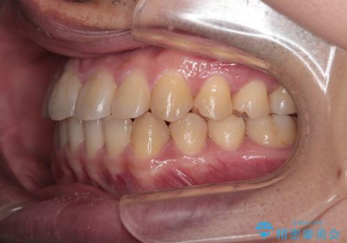 【クリア装置】前歯のがたつきが気になるの治療後