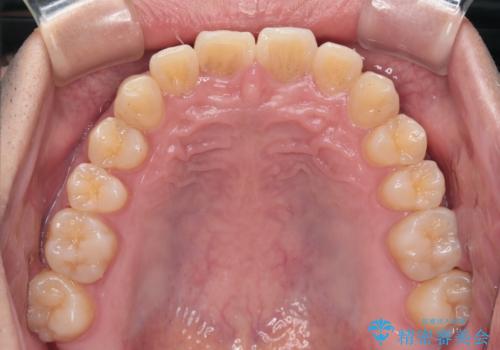 【クリア装置】前歯のがたつきが気になるの治療後