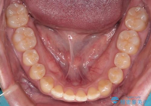 【クリア装置】前歯のがたつきが気になるの治療後