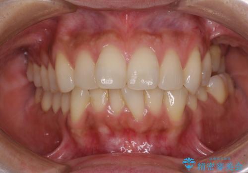 インビザラインによる矯正治療と奥歯のインプラント治療の治療前