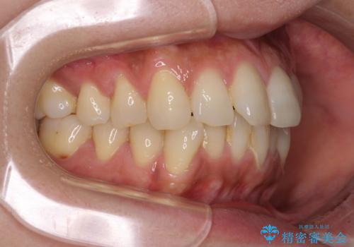 インビザラインによる矯正治療と奥歯のインプラント治療の治療前