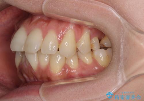 インビザラインによる矯正治療と奥歯のインプラント治療の治療前