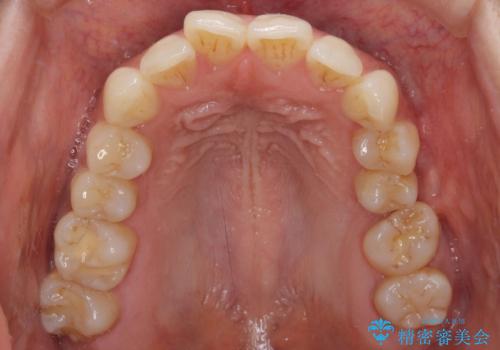 インビザラインによる矯正治療と奥歯のインプラント治療の治療前