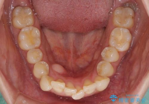 インビザラインによる矯正治療と奥歯のインプラント治療の治療前