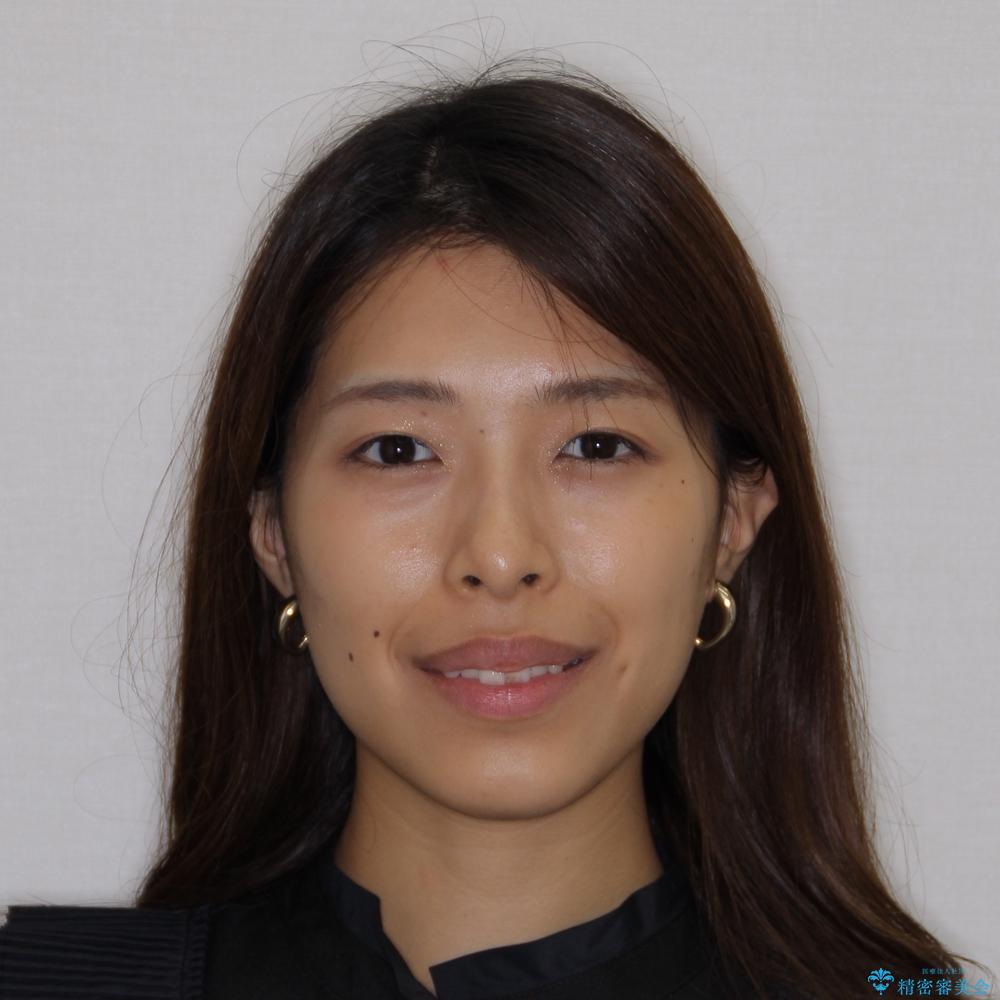 【モニター】突出した前歯 補助装置を併用したインビザライン矯正の治療前(顔貌)