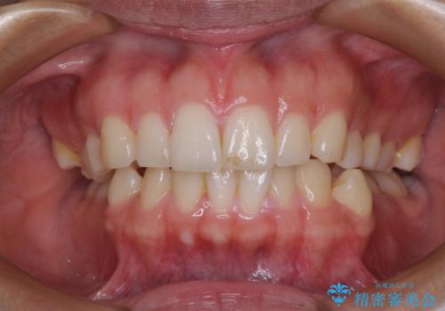 【モニター】突出した前歯 補助装置を併用したインビザライン矯正の治療前