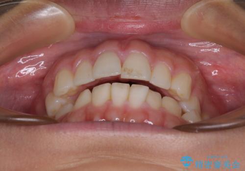 【モニター】突出した前歯 補助装置を併用したインビザライン矯正の治療前