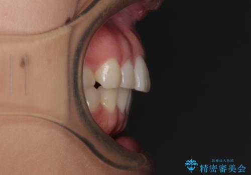 【モニター】突出した前歯 補助装置を併用したインビザライン矯正の治療前