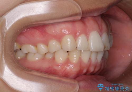 【モニター】突出した前歯 補助装置を併用したインビザライン矯正の治療前