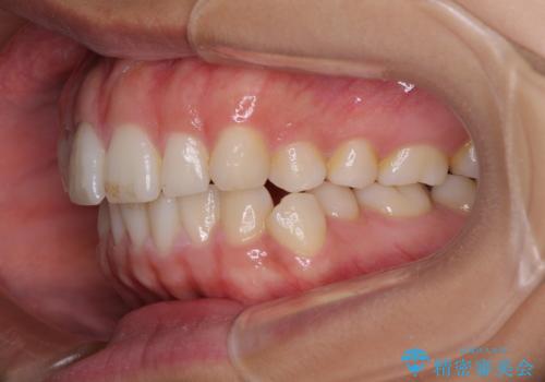 【モニター】突出した前歯 補助装置を併用したインビザライン矯正の治療前