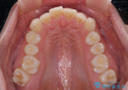 【モニター】突出した前歯 補助装置を併用したインビザライン矯正の治療前