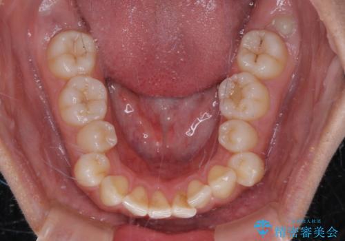 【モニター】突出した前歯 補助装置を併用したインビザライン矯正の治療前