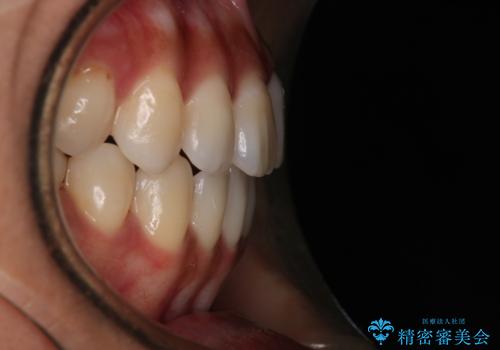 【モニター】開咬(オープンバイト)を治したい ワイヤー装置の治療後
