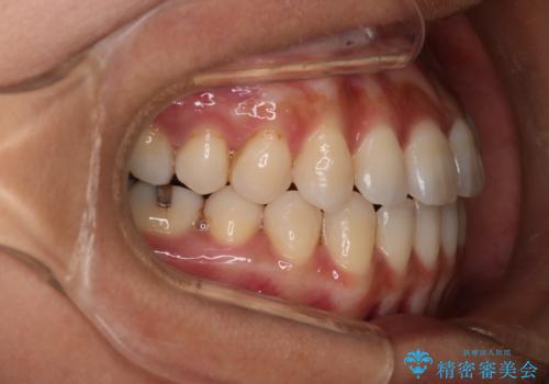 【モニター】開咬(オープンバイト)を治したい ワイヤー装置の治療後