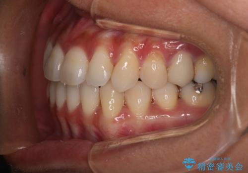 【モニター】開咬(オープンバイト)を治したい ワイヤー装置の治療後