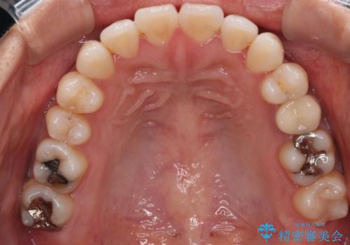 【モニター】開咬(オープンバイト)を治したい ワイヤー装置の治療後