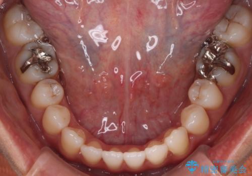 【モニター】開咬(オープンバイト)を治したい ワイヤー装置の治療後